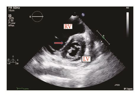 d shaped septum - flattening of the interventricular septum.